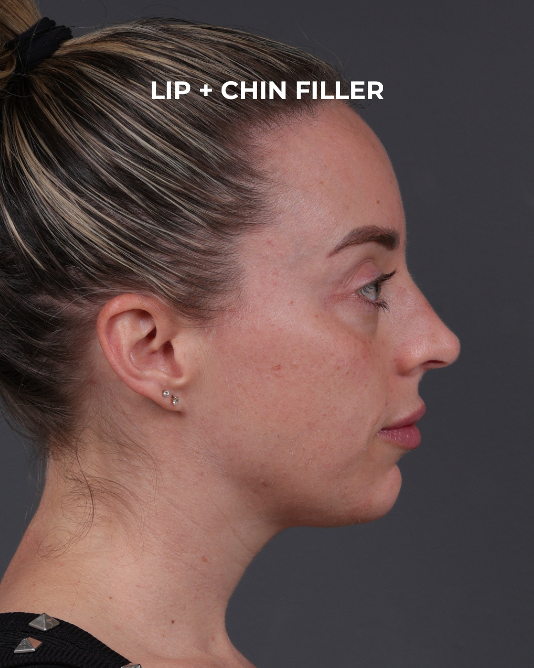 Dermal Fillers Before & After Gallery - Patient 916688 - Image 6