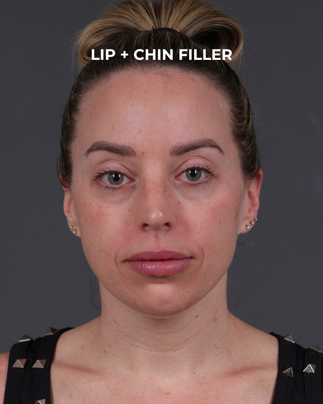 Dermal Fillers Before & After Gallery - Patient 916688 - Image 2