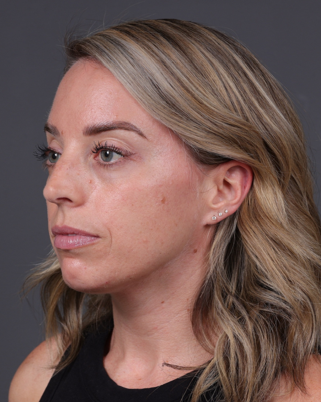 Dermal Fillers Before & After Gallery - Patient 916688 - Image 7