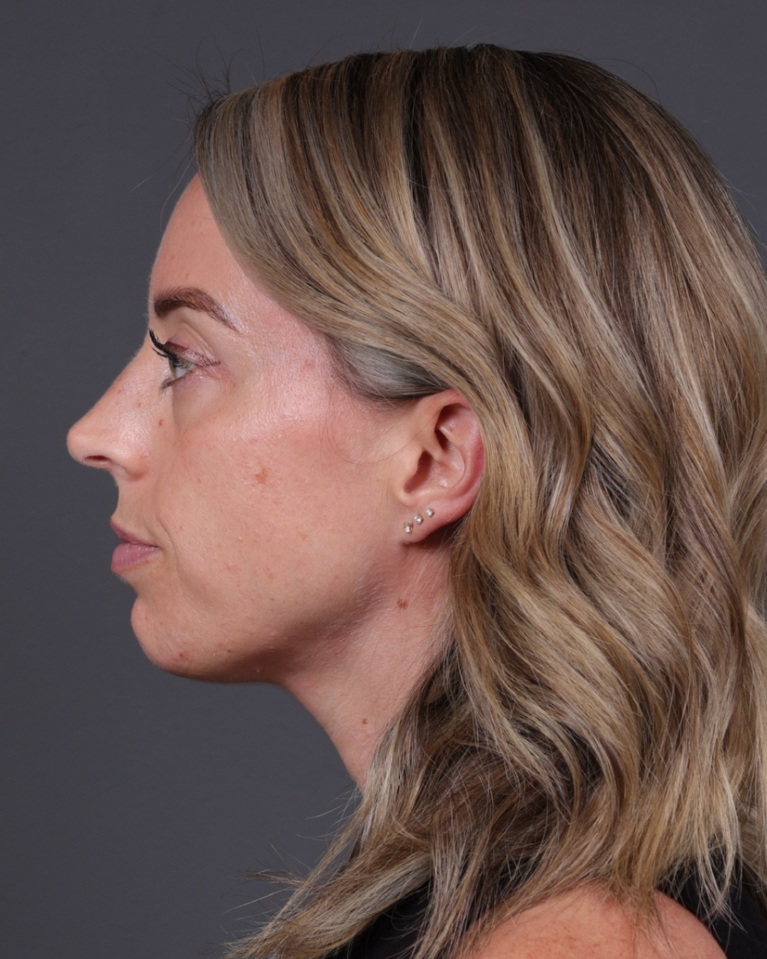 Dermal Fillers Before & After Gallery - Patient 916688 - Image 9