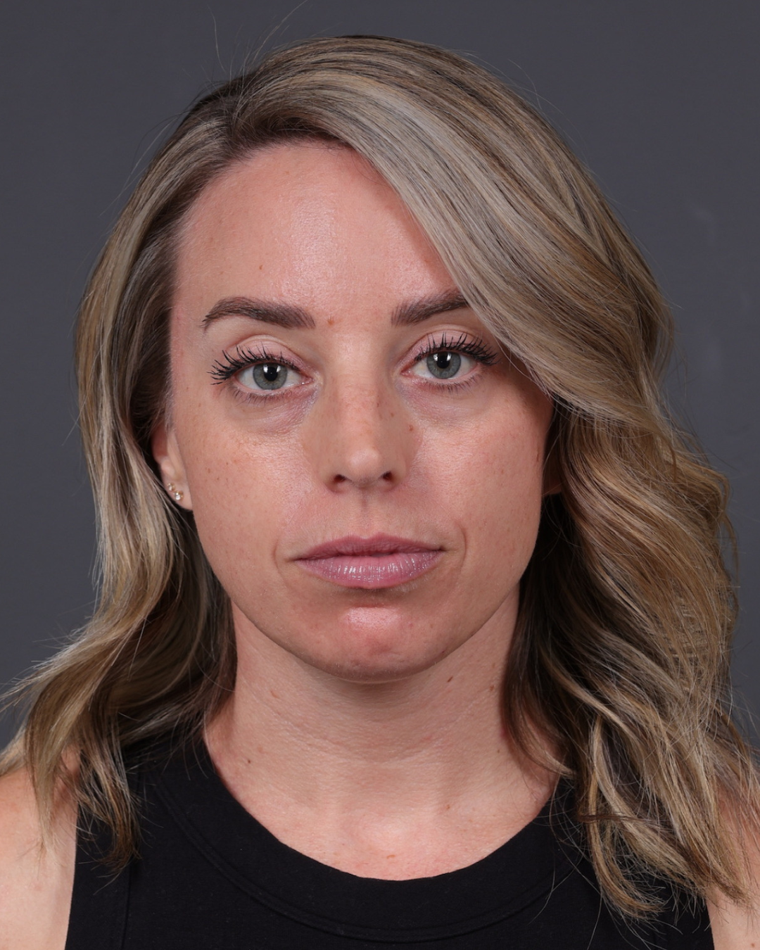 Dermal Fillers Before & After Gallery - Patient 916688 - Image 1