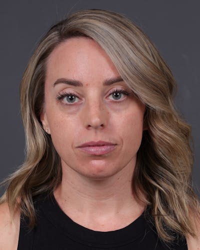 Dermal Fillers Before & After Gallery - Patient 916688 - Image 1
