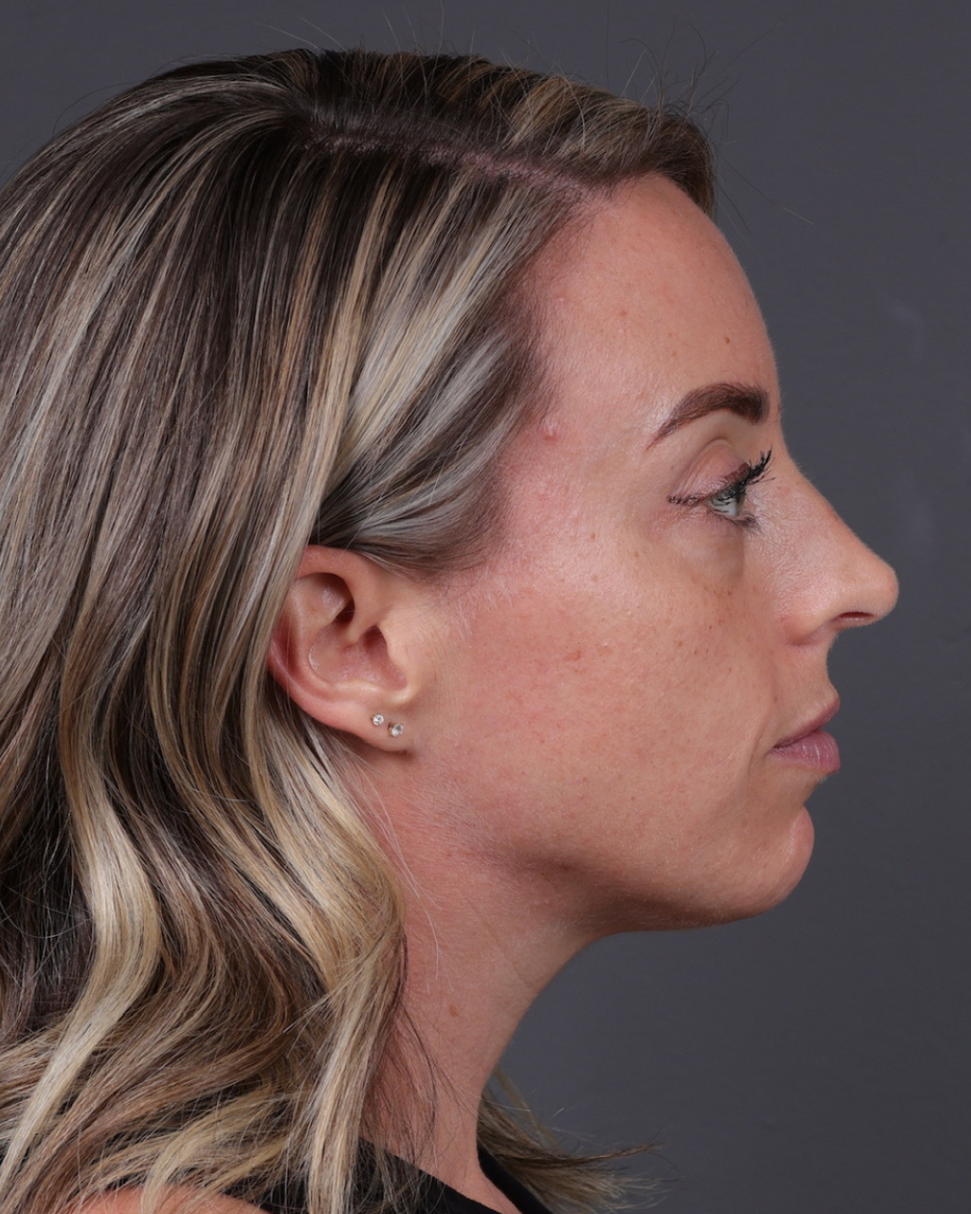 Dermal Fillers Before & After Gallery - Patient 916688 - Image 5