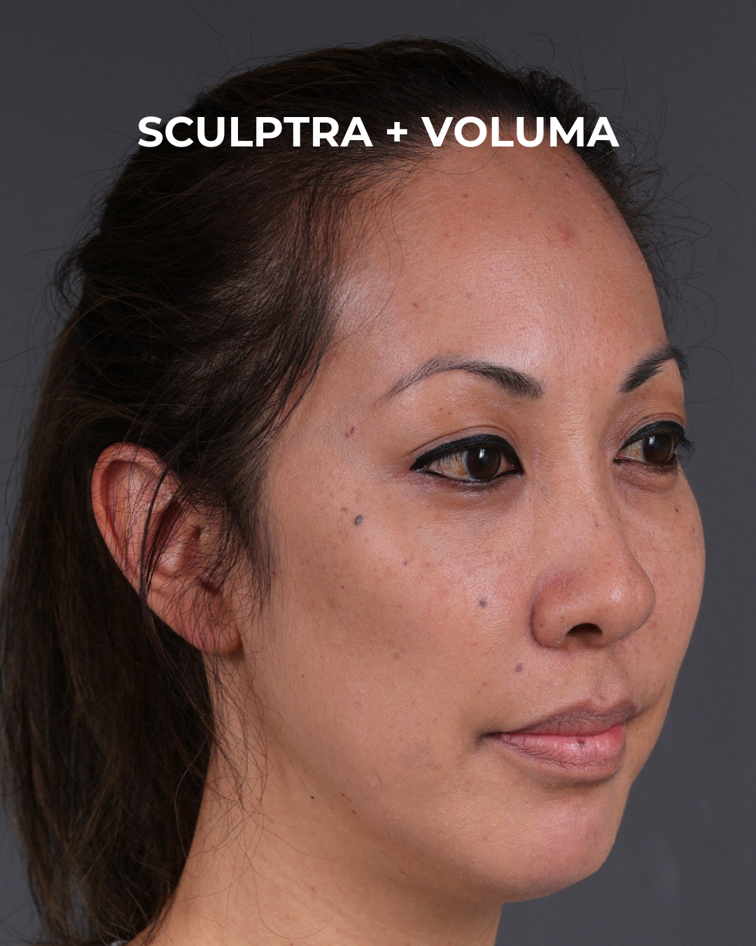 Dermal Fillers Before & After Gallery - Patient 172558 - Image 4