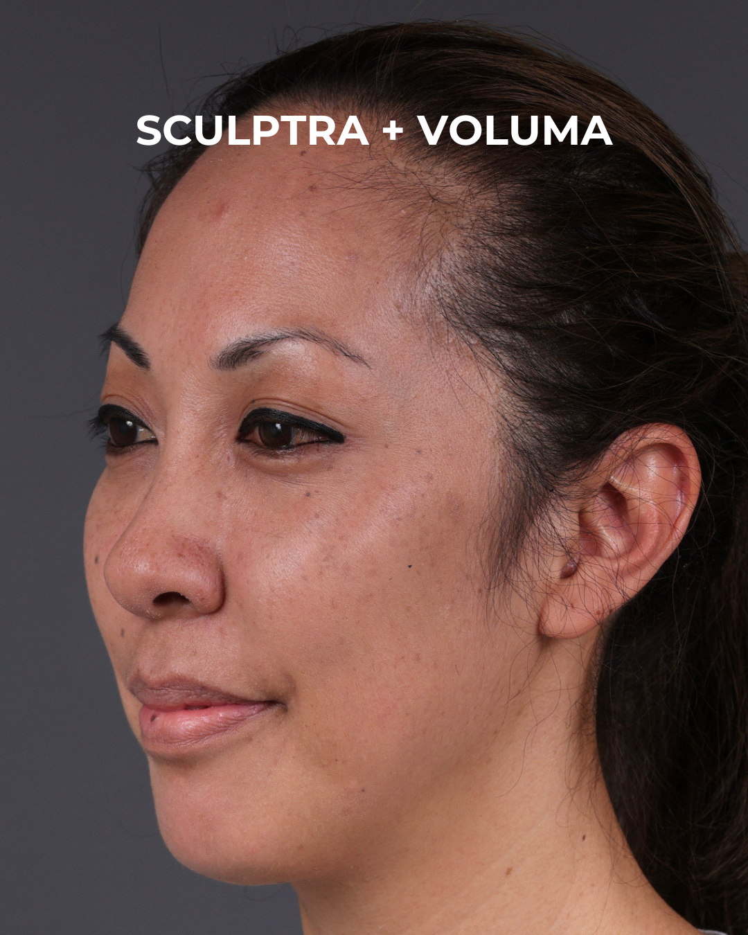 Dermal Fillers Before & After Gallery - Patient 172558 - Image 6