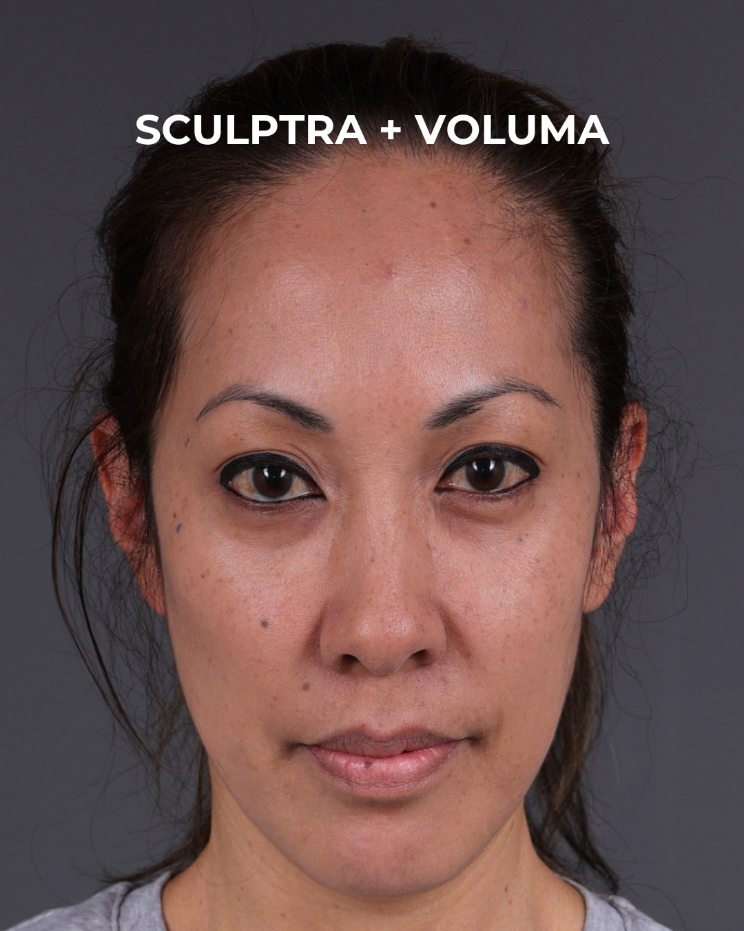 Dermal Fillers Before & After Gallery - Patient 172558 - Image 2