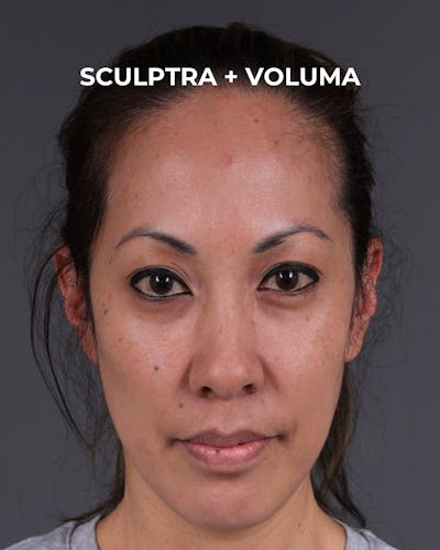 Dermal Fillers Before & After Gallery - Patient 172558 - Image 2