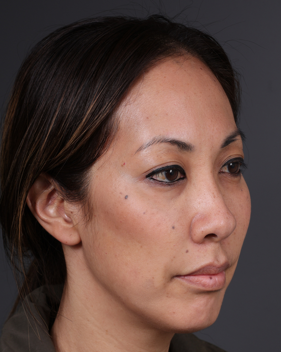Dermal Fillers Before & After Gallery - Patient 172558 - Image 3