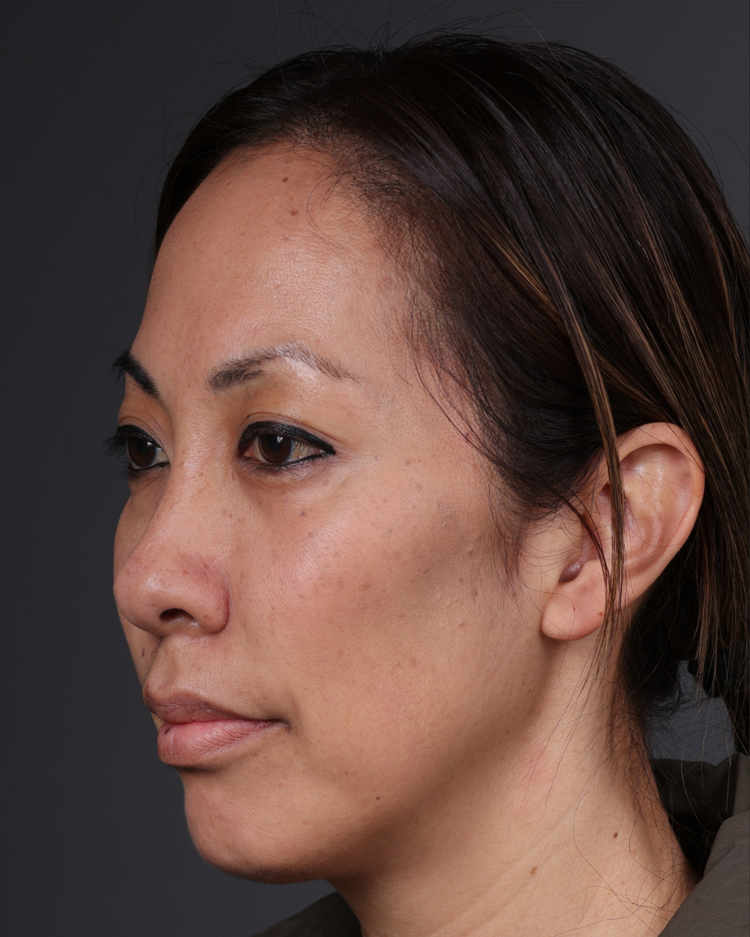 Dermal Fillers Before & After Gallery - Patient 172558 - Image 5