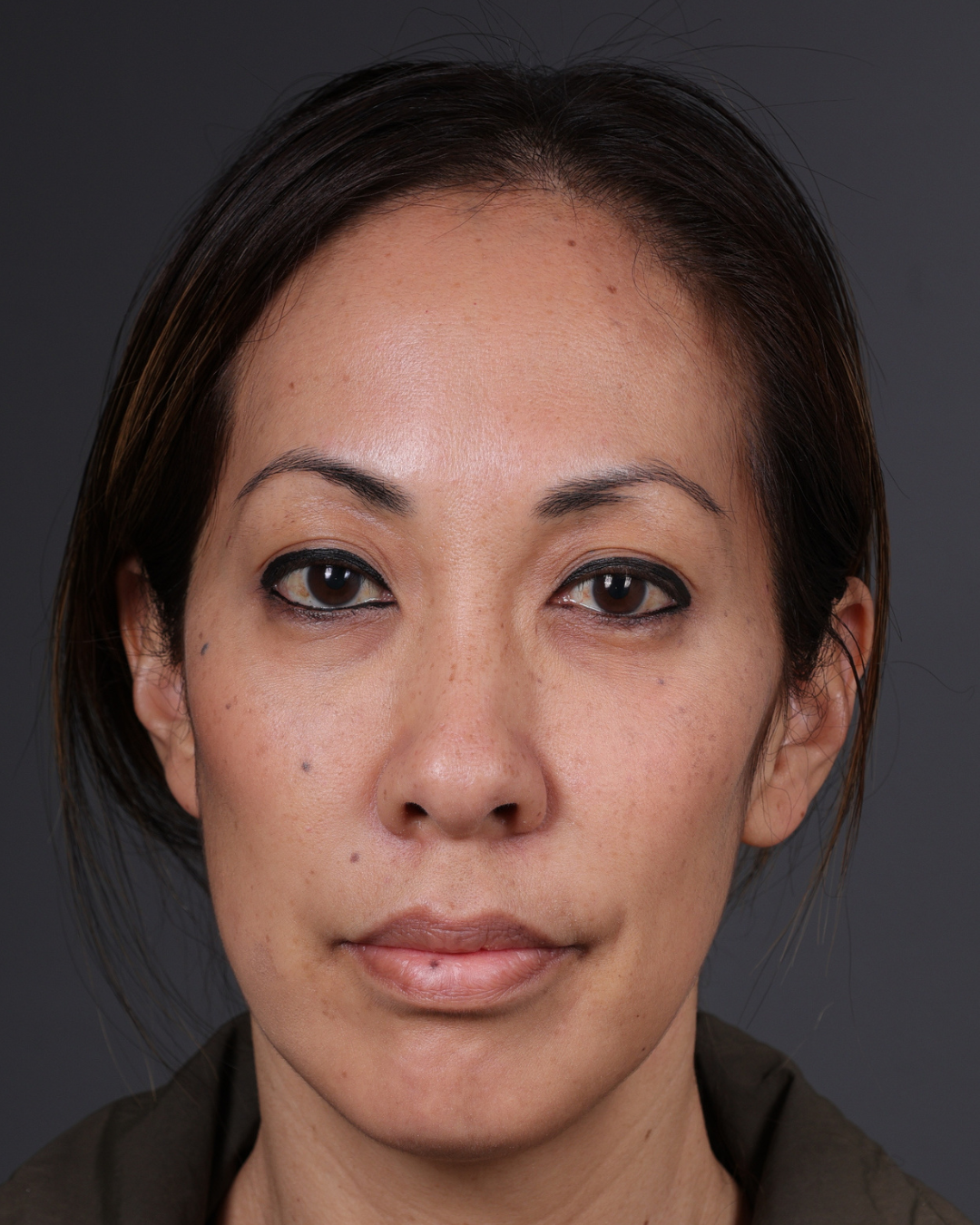 Dermal Fillers Before & After Gallery - Patient 172558 - Image 1