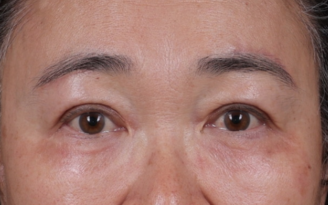 Brow Lift Before & After Gallery - Patient 221050 - Image 2