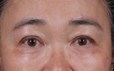 Blepharoplasty Before & After Gallery - Patient 140258 - Image 2