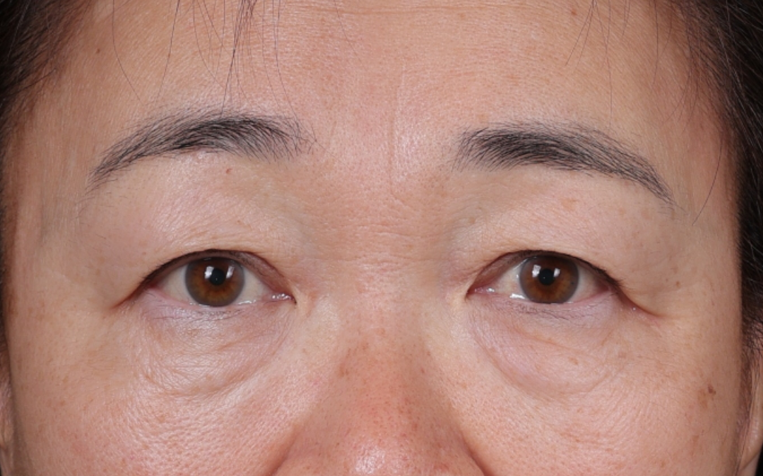 Brow Lift Before & After Gallery - Patient 221050 - Image 1