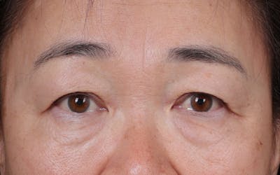 Blepharoplasty Before & After Gallery - Patient 140258 - Image 1