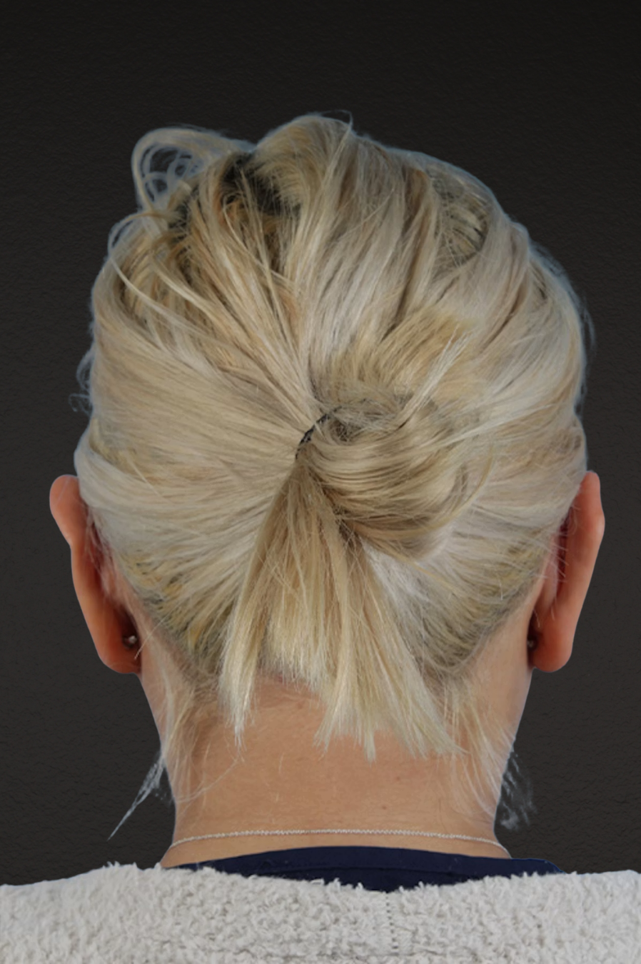 Otoplasty Before & After Gallery - Patient 302523 - Image 2