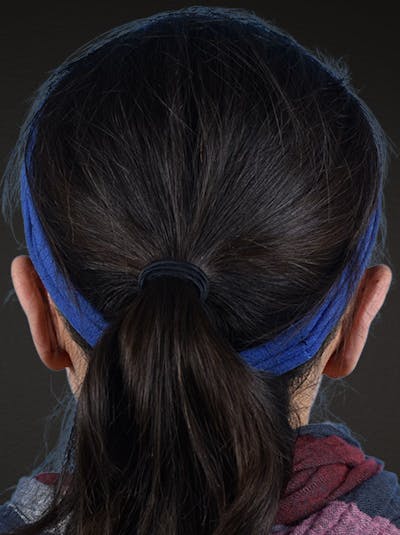 Otoplasty Before & After Gallery - Patient 260468 - Image 1
