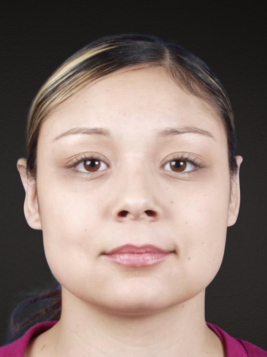 Otoplasty Before & After Gallery - Patient 316708 - Image 2