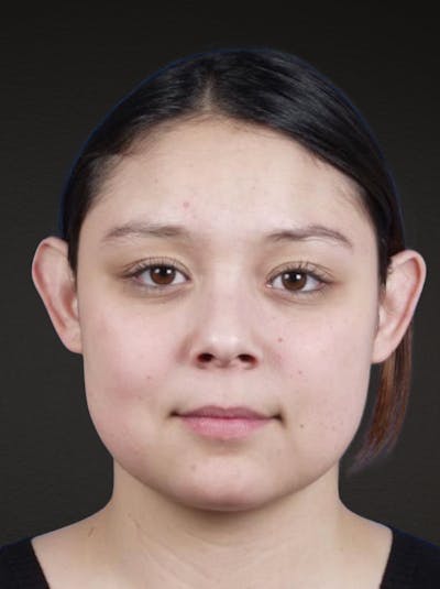 Otoplasty Before & After Gallery - Patient 316708 - Image 1