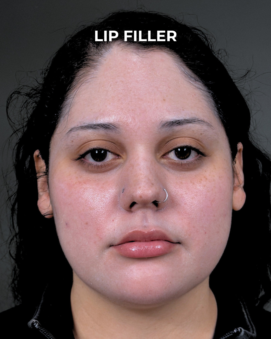 Dermal Fillers Before & After Gallery - Patient 203654 - Image 2