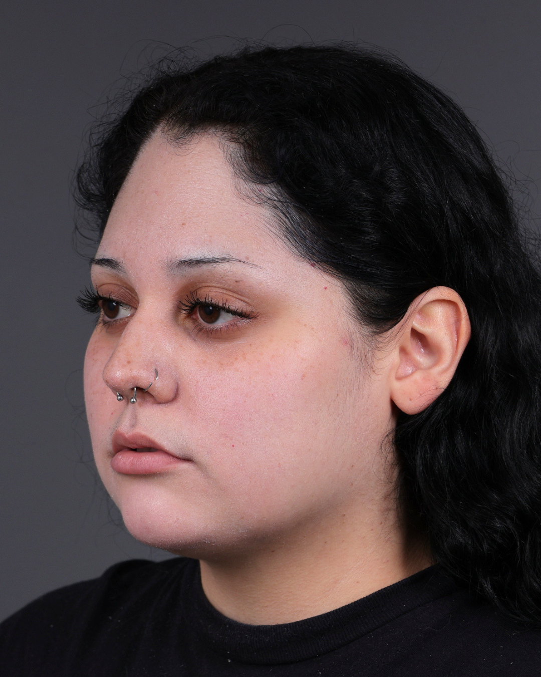 Dermal Fillers Before & After Gallery - Patient 203654 - Image 3