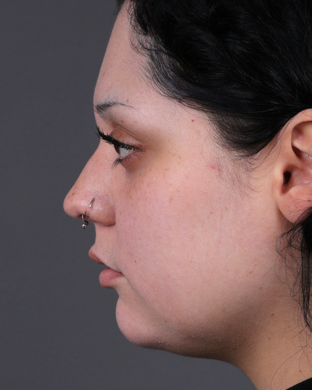 Dermal Fillers Before & After Gallery - Patient 203654 - Image 5