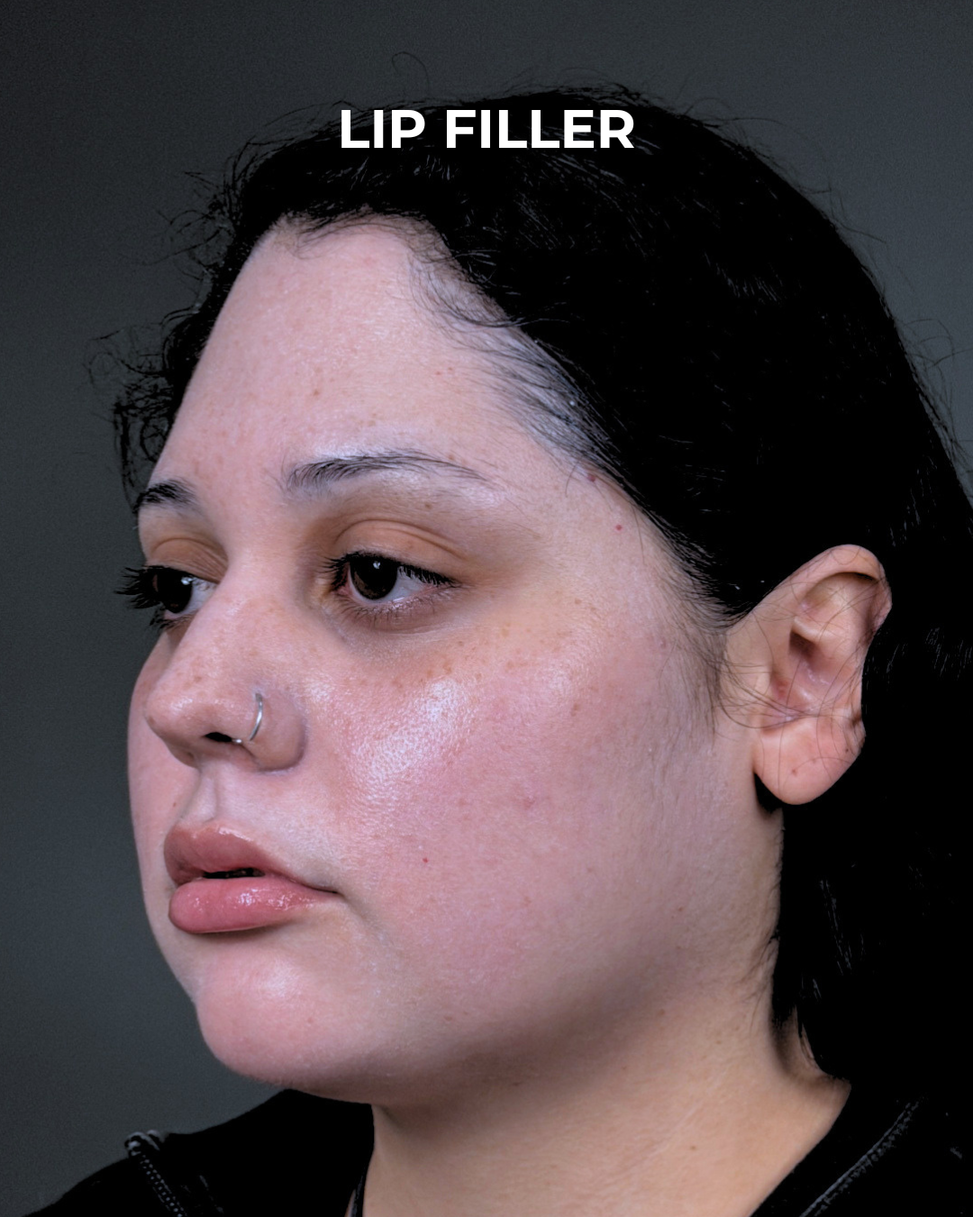 Dermal Fillers Before & After Gallery - Patient 203654 - Image 4