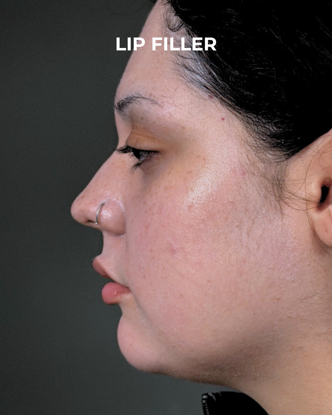 Dermal Fillers Before & After Gallery - Patient 203654 - Image 6