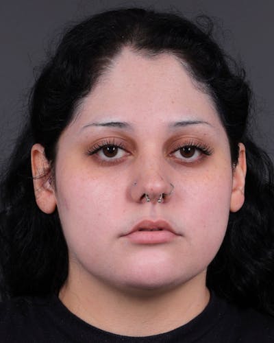Dermal Fillers Before & After Gallery - Patient 203654 - Image 1