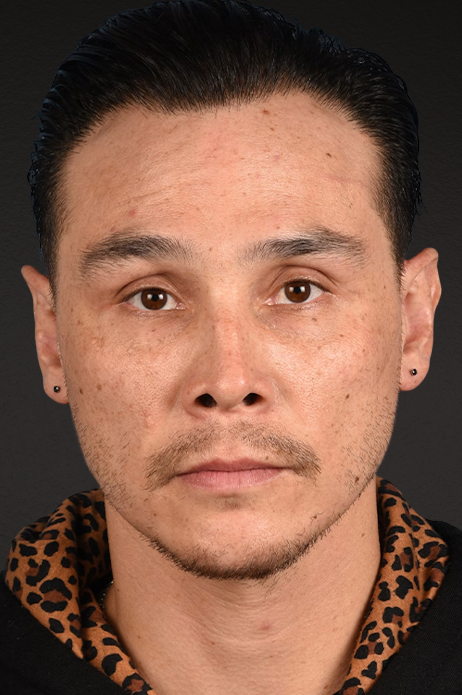 Hair Transplant With NeoGraft Before & After Gallery - Patient 494446 - Image 2