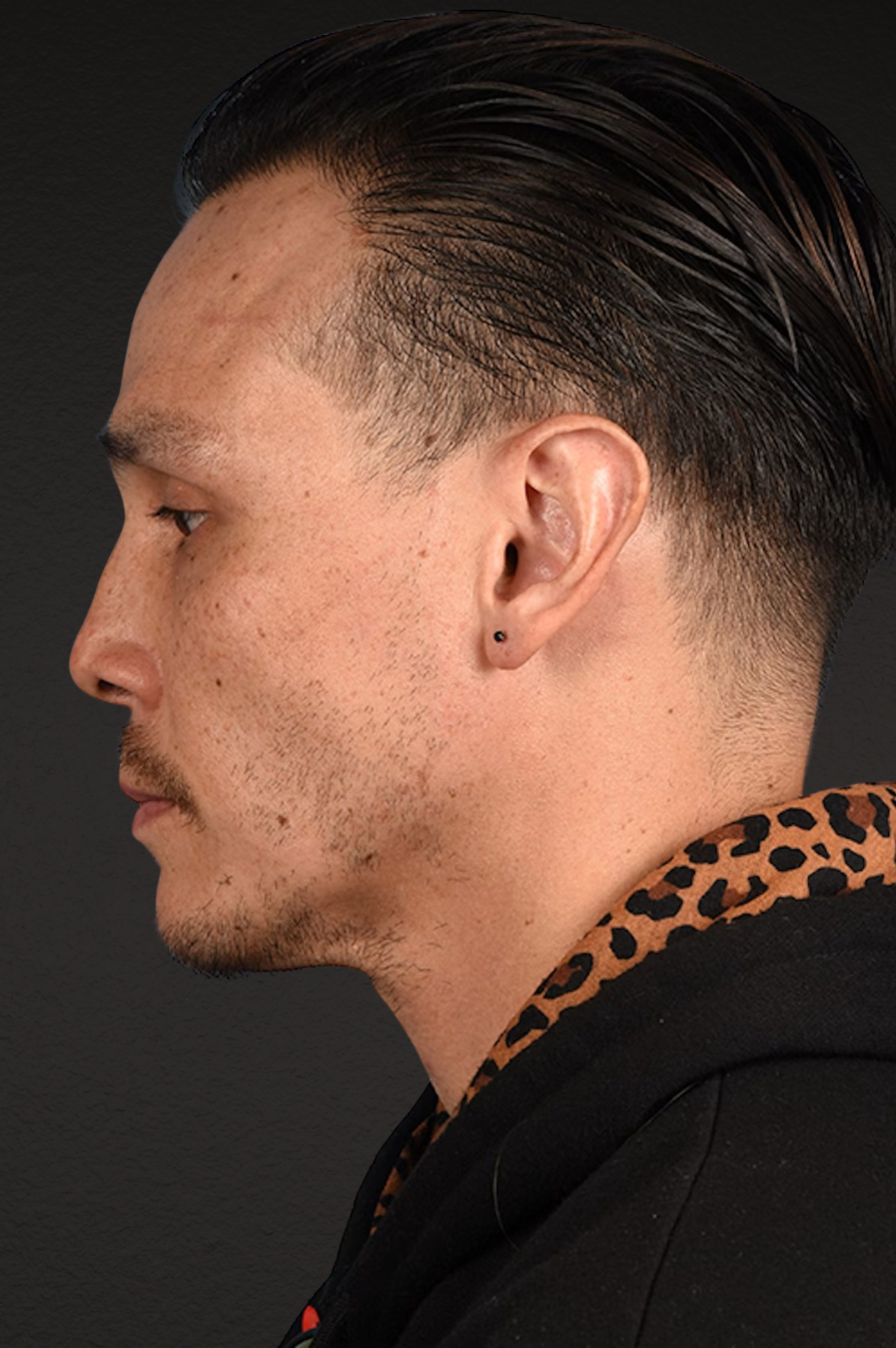 Hair Transplant With NeoGraft Before & After Gallery - Patient 494446 - Image 4