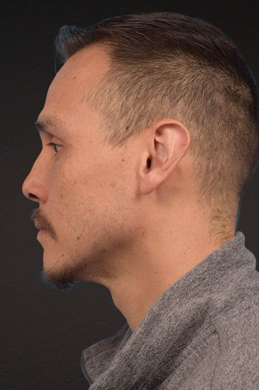 Hair Transplant With NeoGraft Before & After Gallery - Patient 494446 - Image 3