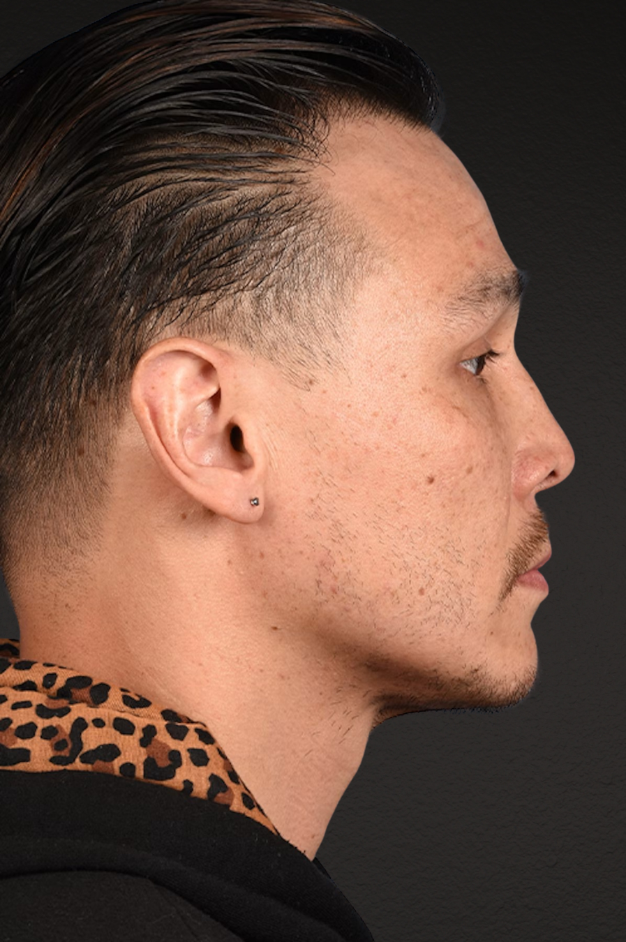 Hair Transplant With NeoGraft Before & After Gallery - Patient 494446 - Image 6