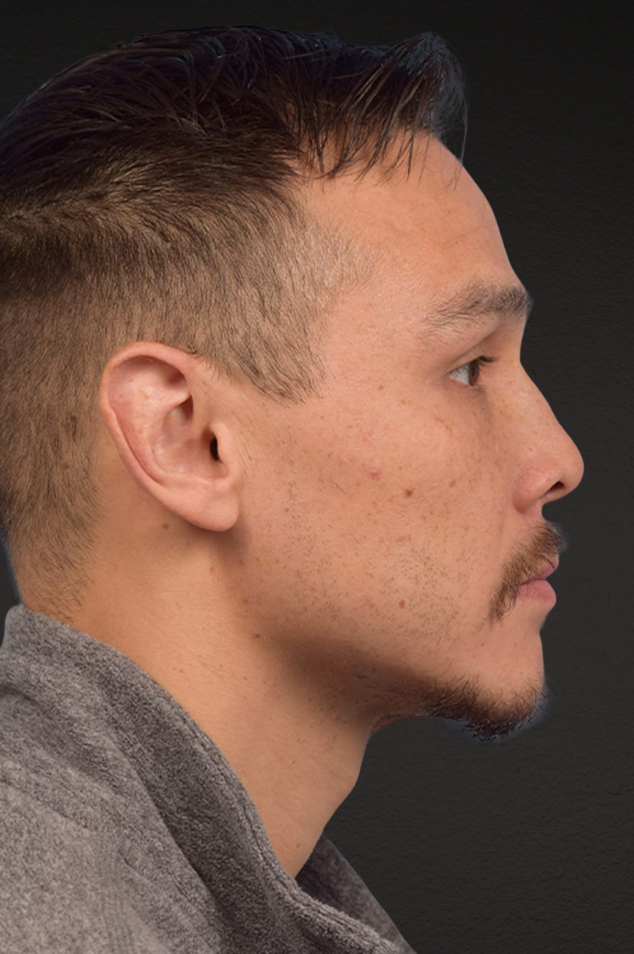 Hair Transplant With NeoGraft Before & After Gallery - Patient 494446 - Image 5