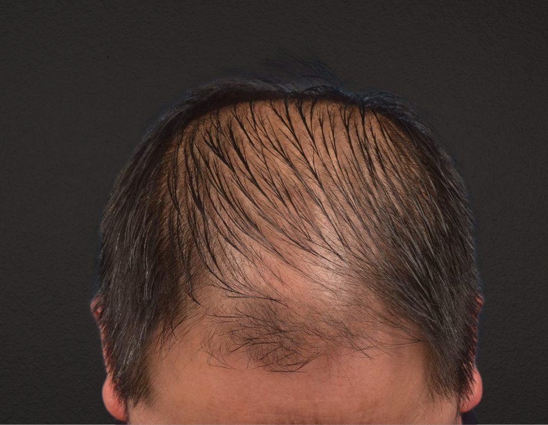 Hair Transplant With NeoGraft Before & After Gallery - Patient 242971 - Image 1