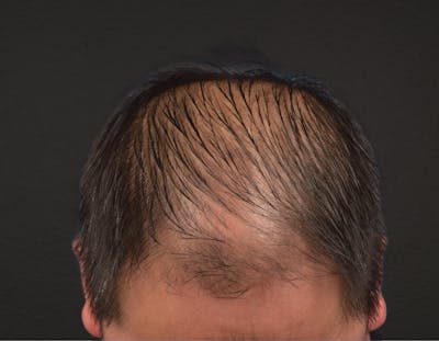 Hair Transplant With NeoGraft Before & After Gallery - Patient 242971 - Image 1