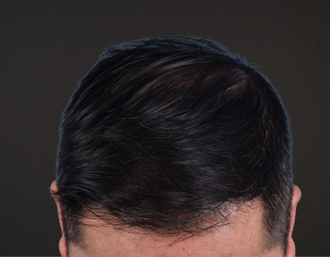 Hair Transplant With NeoGraft Before & After Gallery - Patient 242971 - Image 2