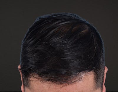 Hair Transplant With NeoGraft Before & After Gallery - Patient 242971 - Image 2