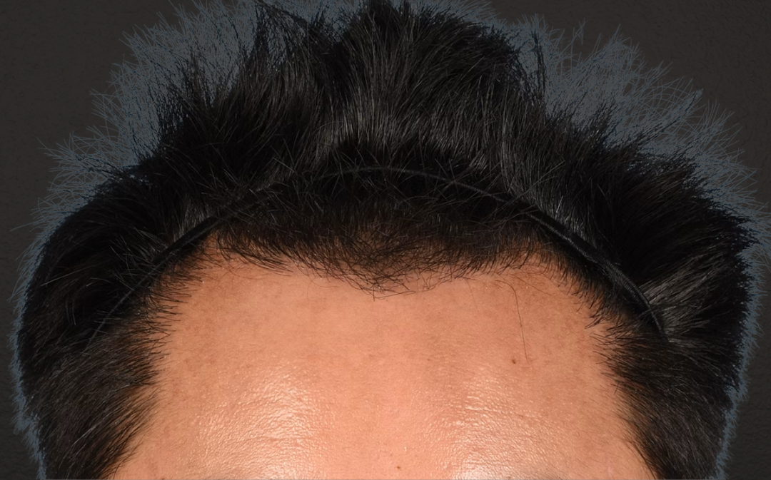 Hair Transplant With NeoGraft Before & After Gallery - Patient 421962 - Image 2