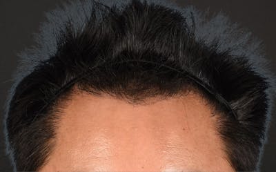Hair Transplant With NeoGraft Before & After Gallery - Patient 421962 - Image 2