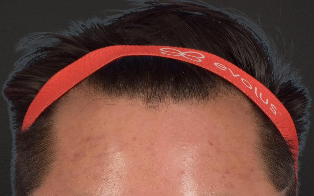 Hair Transplant With NeoGraft Before & After Gallery - Patient 421962 - Image 1