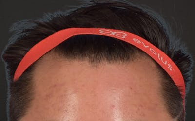 Hair Transplant With NeoGraft Before & After Gallery - Patient 421962 - Image 1