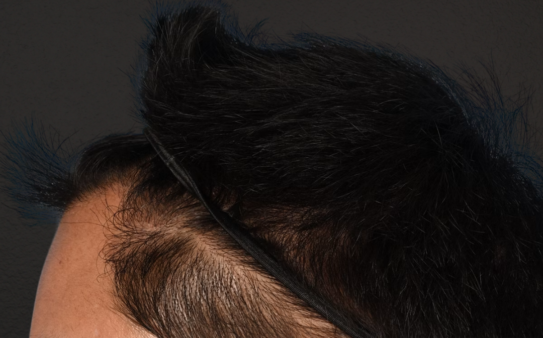 Hair Transplant With NeoGraft Before & After Gallery - Patient 421962 - Image 6
