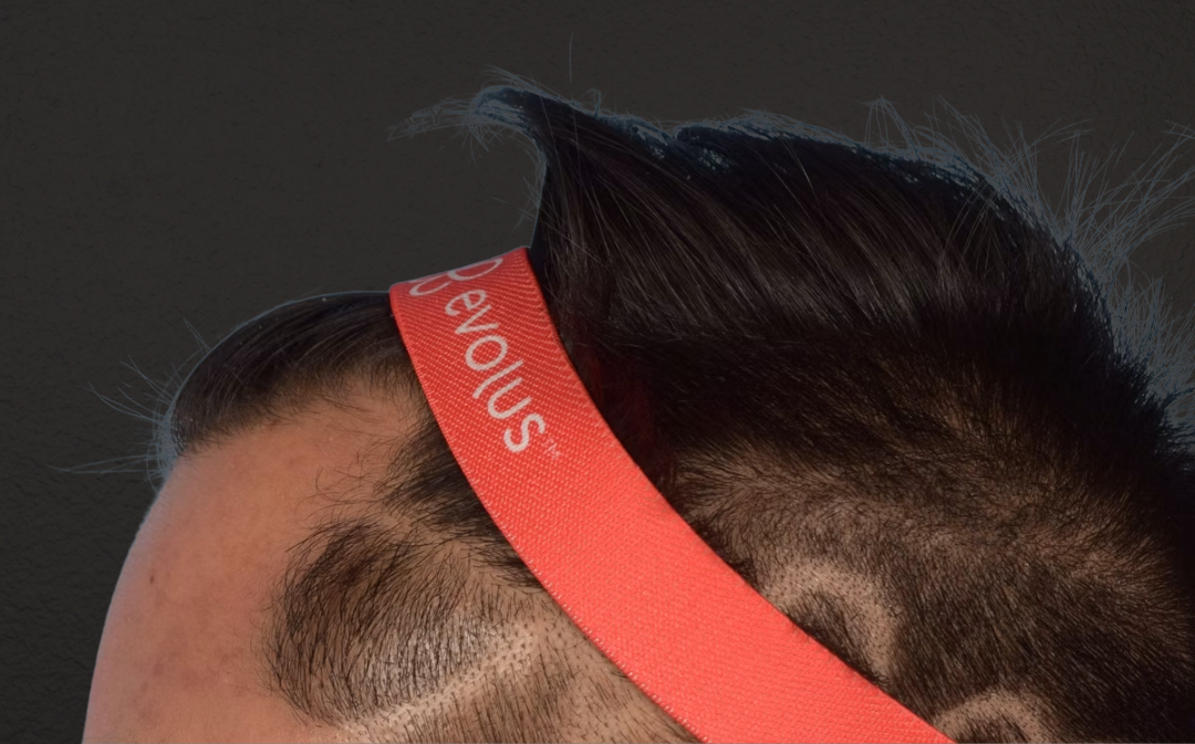 Hair Transplant With NeoGraft Before & After Gallery - Patient 421962 - Image 5