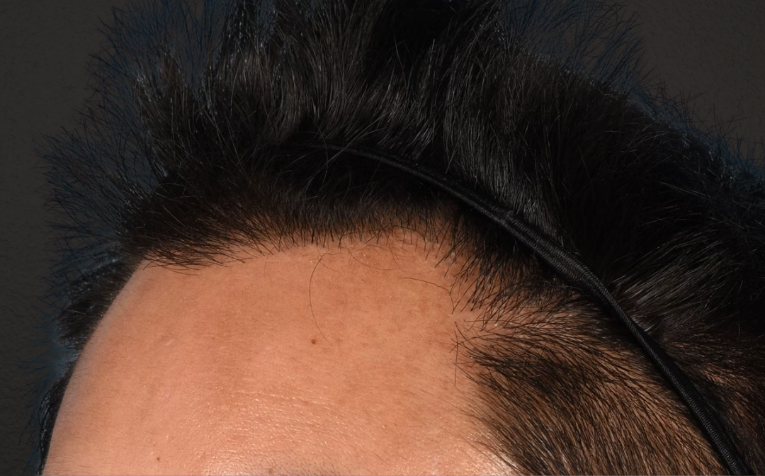Hair Transplant With NeoGraft Before & After Gallery - Patient 421962 - Image 8