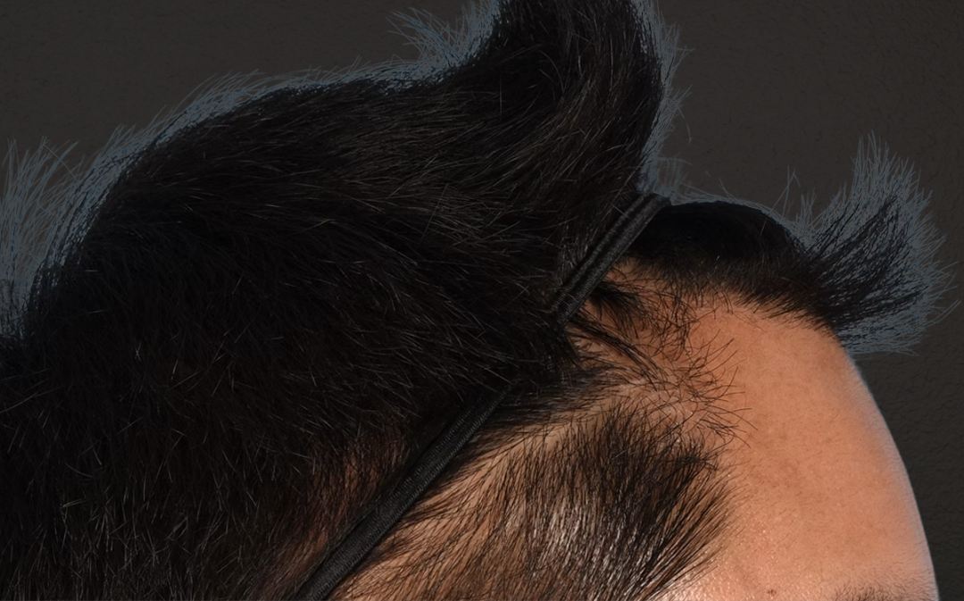 Hair Transplant With NeoGraft Before & After Gallery - Patient 421962 - Image 10