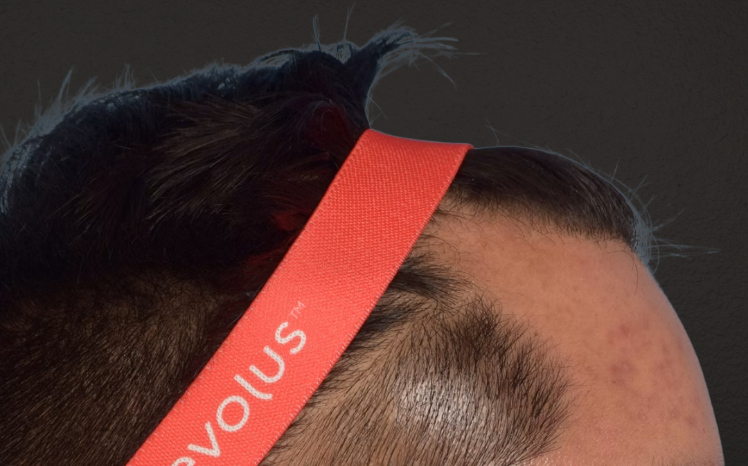 Hair Transplant With NeoGraft Before & After Gallery - Patient 421962 - Image 9