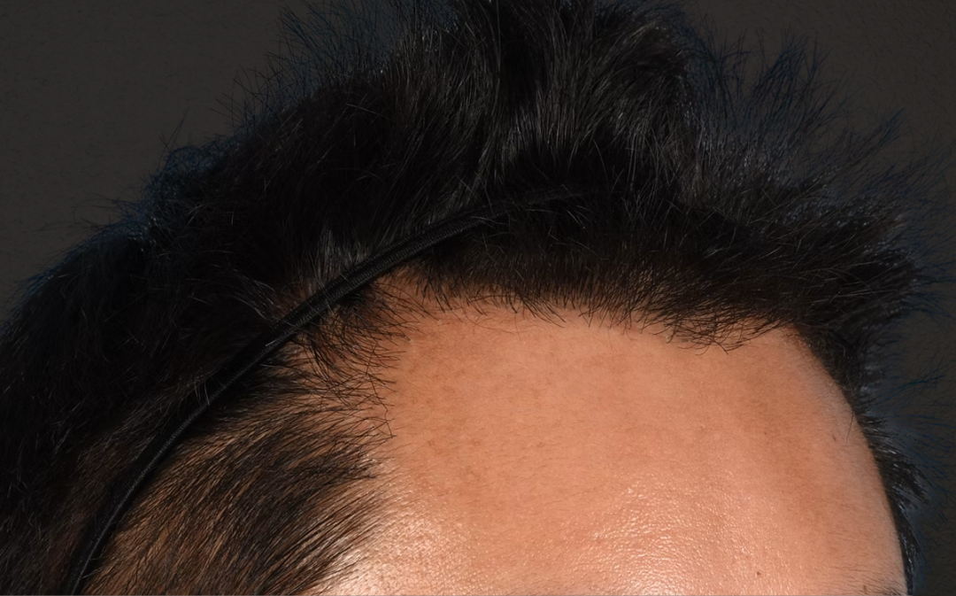 Hair Transplant With NeoGraft Before & After Gallery - Patient 421962 - Image 4