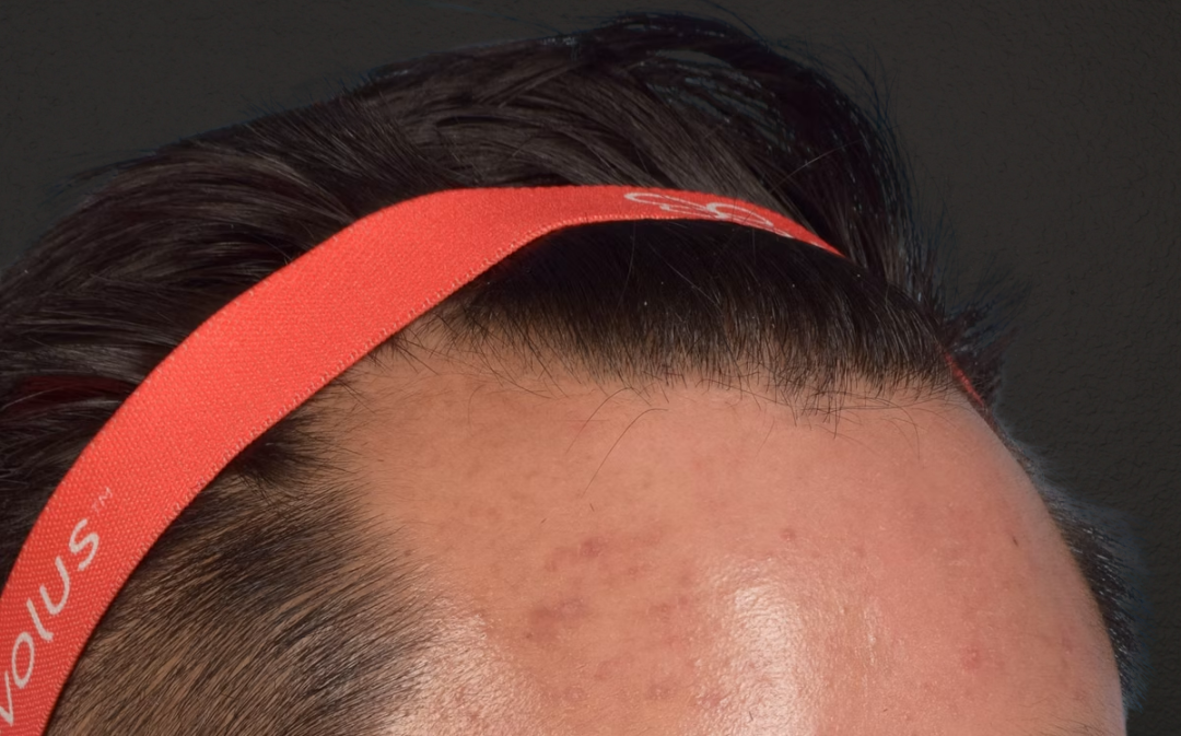 Hair Transplant With NeoGraft Before & After Gallery - Patient 421962 - Image 3