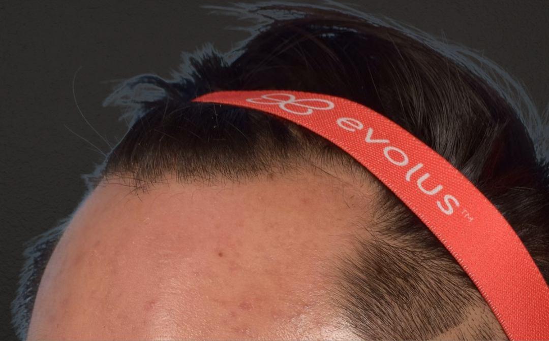 Hair Transplant With NeoGraft Before & After Gallery - Patient 421962 - Image 7