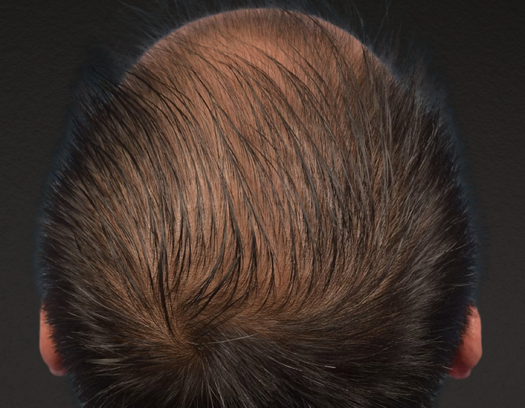 Hair Transplant With NeoGraft Before & After Gallery - Patient 242971 - Image 3
